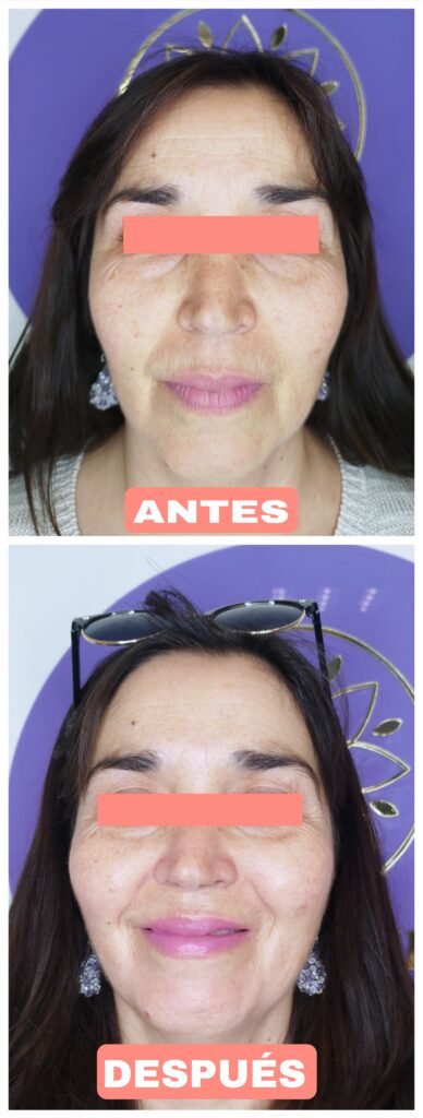 Fotografía antes después en limpieza facial 